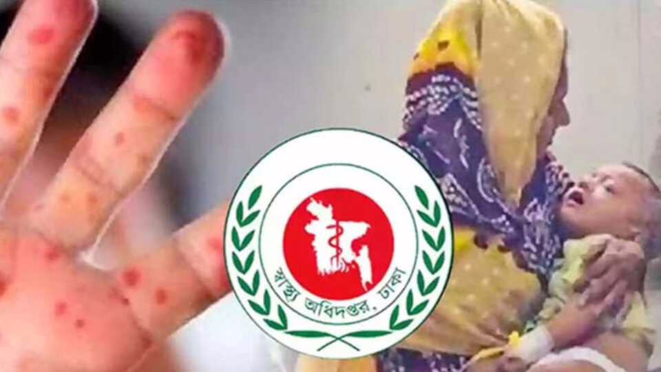 হাম উপসর্গে আরও ৫ শিশুর মৃত্যু
